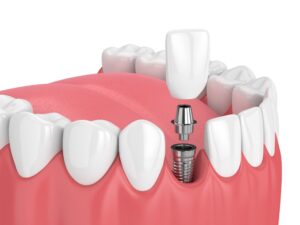 implant-dentaire-visse-couronne